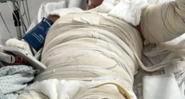Gabriele Cristine Barreto in a hospital bed with burn bandages.