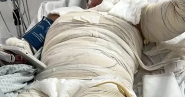 Gabriele Cristine Barreto in a hospital bed with burn bandages.