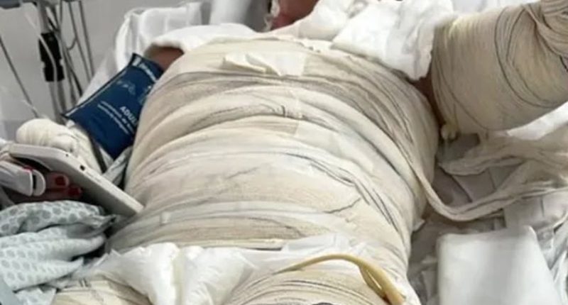 Gabriele Cristine Barreto in a hospital bed with burn bandages.