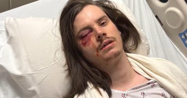 Protester Marshall Woodruff shot in the eye with rubber bullet during 'No Kings Day' rally in downtown Los Angeles Saturday