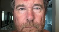 Close-up of a man's forehead with a large, red, and bloody wound.