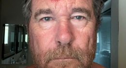 Close-up of a man's forehead with a large, red, and bloody wound.