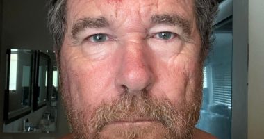 Close-up of a man's forehead with a large, red, and bloody wound.