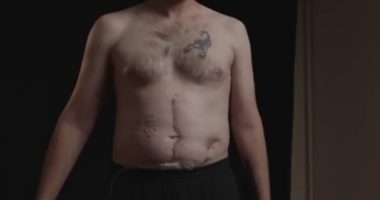 Ukrainian PoW with ‘Glory to Russia’ BURNED on skin says sick ‘Calling Putin’ torture method left him begging for death