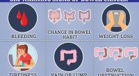 Bowel cancer can cause blood in the stool, changes in bowel habits and unexplained weight loss