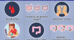 Bowel cancer can cause blood in the stool, changes in bowel habits and unexplained weight loss