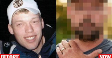 A gunshot left me without half a face... but a groundbreaking transplant changed my life