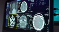 Alzheimer's study makes surprise finding over people who are more sociable