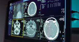 Alzheimer's study makes surprise finding over people who are more sociable