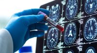 Breakthrough blood test diagnoses Alzheimer's early with 95% accuracy