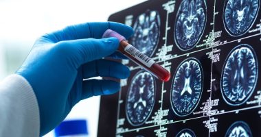 Breakthrough blood test diagnoses Alzheimer's early with 95% accuracy