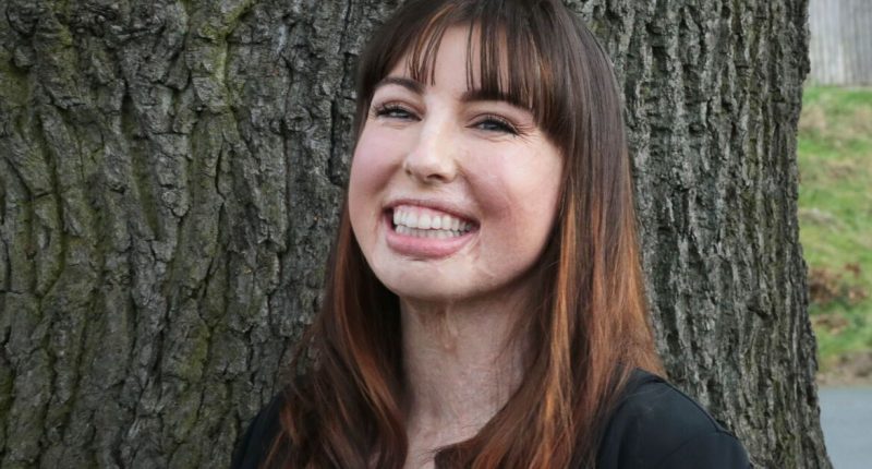 Britain's most badly burned woman feels lucky to be alive and helping patients like her