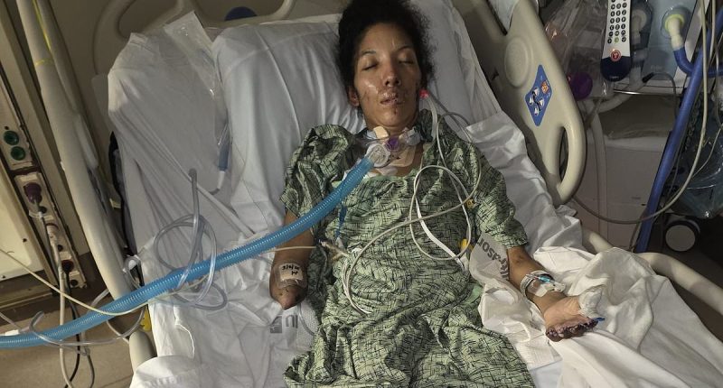 Terrified mom wakes up with all of her limbs amputated after catching two common infections at the same time