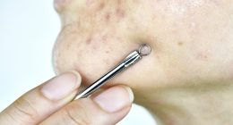 Top dermatologist's urgent warning to those with spots - common remedy could leave you scarred for life