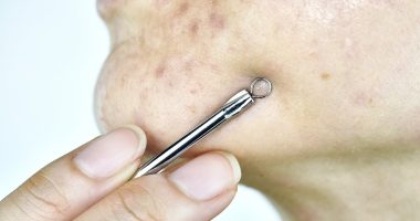 Top dermatologist's urgent warning to those with spots - common remedy could leave you scarred for life