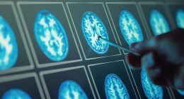 Top scientists flag little-known earliest signs of dementia that have nothing to do with memory