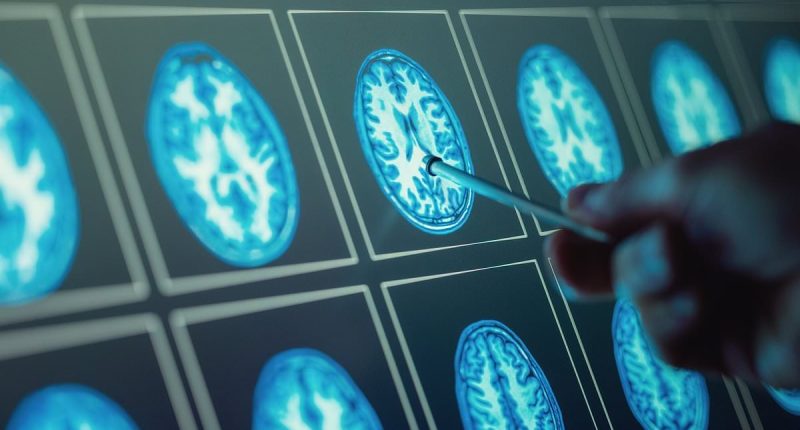 Top scientists flag little-known earliest signs of dementia that have nothing to do with memory