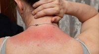 Weird 1p period pad tip that can soothe sunburn pain