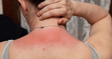 Weird 1p period pad tip that can soothe sunburn pain