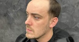 When I started balding in my teens I was so insecure. Then I discovered the hair-loss miracle men whisper about and it changed my life. No, it's NOT a transplant - you'll never guess my secret