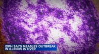 2025 Illinois measles cases: Health officials declare end of outbreak in southern Illinois