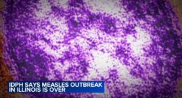 2025 Illinois measles cases: Health officials declare end of outbreak in southern Illinois
