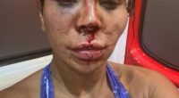 Close-up photo of a woman with severe facial injuries.