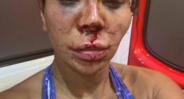 Close-up photo of a woman with severe facial injuries.