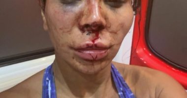 Close-up photo of a woman with severe facial injuries.