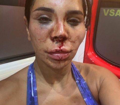 Close-up photo of a woman with severe facial injuries.