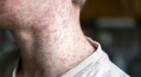 DPH confirms case of measles in South Carolina