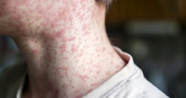 DPH confirms case of measles in South Carolina