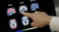 Eating eggs weekly may lower Alzheimer's risk by nearly 50%: Study