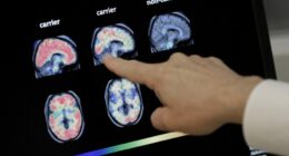 Eating eggs weekly may lower Alzheimer's risk by nearly 50%: Study