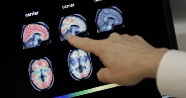 Eating eggs weekly may lower Alzheimer's risk by nearly 50%: Study