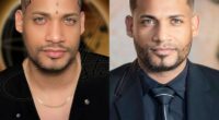 Hair transplants in the U.S. vs. Turkey