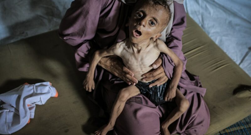 Severely malnourished child held by a woman.