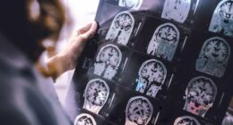 Dementia is one of the leading causes of death in Australia but a new finding could revolutionise detection and treatment.