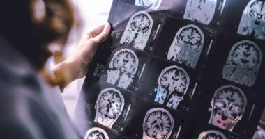 Dementia is one of the leading causes of death in Australia but a new finding could revolutionise detection and treatment.