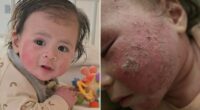 Nikki's baby had a common rash. She says withdrawal from the treatment was even worse