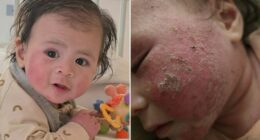 Nikki's baby had a common rash. She says withdrawal from the treatment was even worse