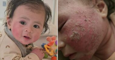 Nikki's baby had a common rash. She says withdrawal from the treatment was even worse