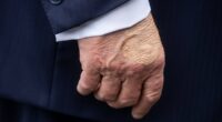 White House reveals cause of Trump's 'swelling' on hands and legs