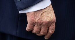 White House reveals cause of Trump's 'swelling' on hands and legs