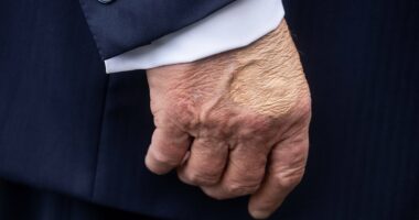 White House reveals cause of Trump's 'swelling' on hands and legs