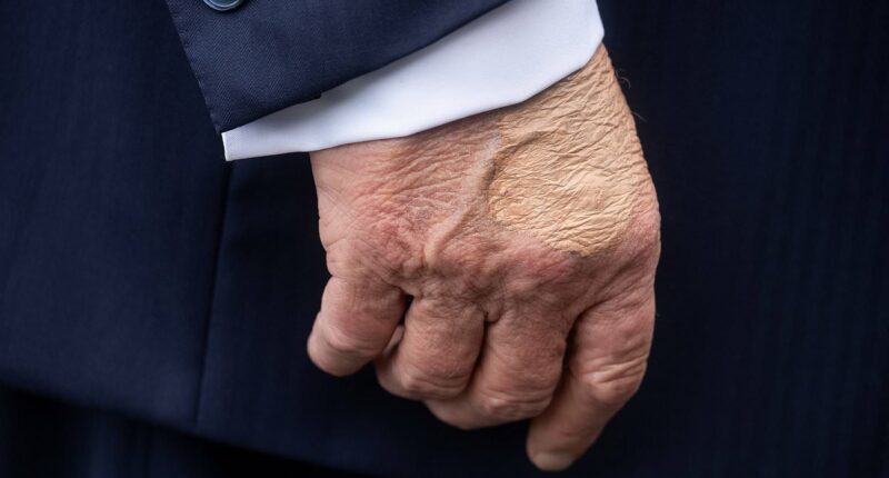 White House reveals cause of Trump's 'swelling' on hands and legs