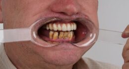 'I sawed out my rotting teeth with a shoelace-I thought it would be like shelling peas but I was very wrong'