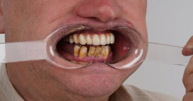 'I sawed out my rotting teeth with a shoelace-I thought it would be like shelling peas but I was very wrong'