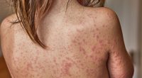 America's measles outbreak hits terrifying milestone as doctors reveal what 95% of victims have in common