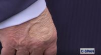 Fears for Donald Trump's health after eagle-eyed Americans spot mysterious markings across his body... as experts reveal what's wrong with him